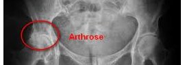 Arthrose de la hanche