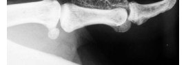 Ostéochondromatose synoviale du poignet