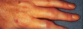 Arthrite rhumatoïde du poignet