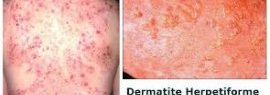 Dermatite herpétiforme