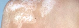 Soigner le vitiligo par l'aloe vera