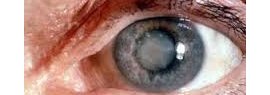 Cataracte et homéopathie